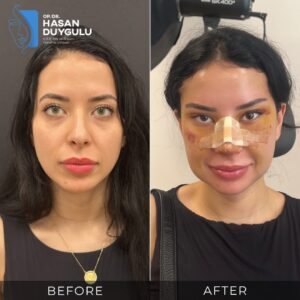 Fotografije pre i posle operacije lisičjih očiju u Turskoj