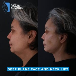 duboko-ravno-i-podizanje-vrata