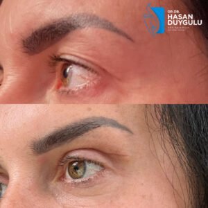 podizanje-mačjih-očiju-pre-i-posle