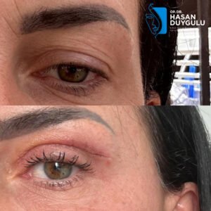 operacija-mačjih-očiju-u-turskoj