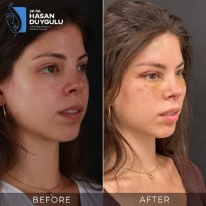 Фотографије пре и после подизања лица у Турској