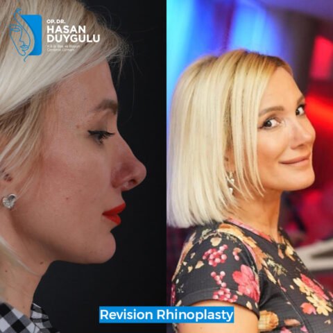 rinoplastika-posle-operacije-u-istanbulu