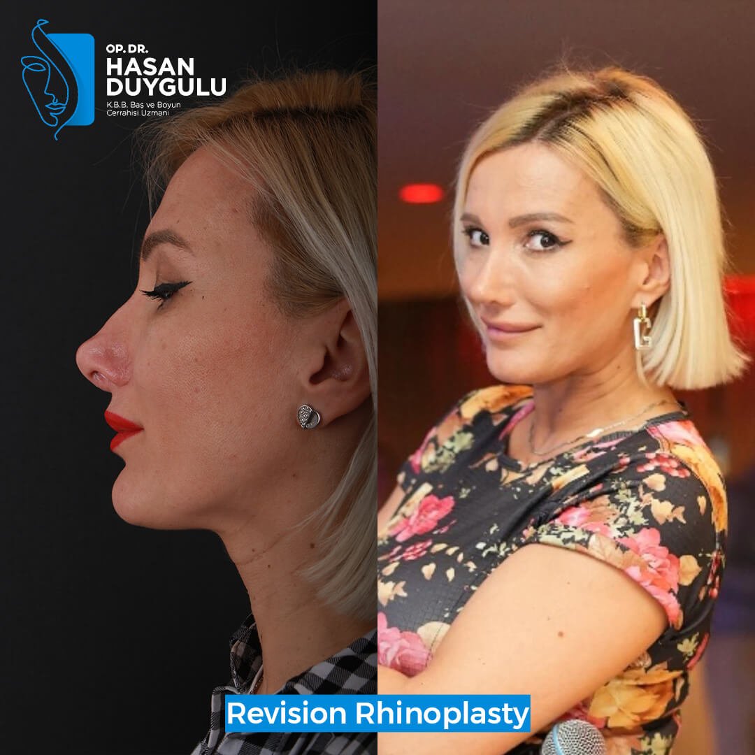 Галерија ринопластике Турска