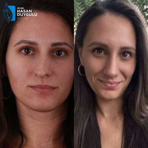 rinoplastika-operacija-turska-istanbul