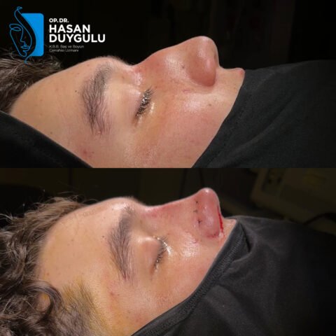 rinoplastika-turska