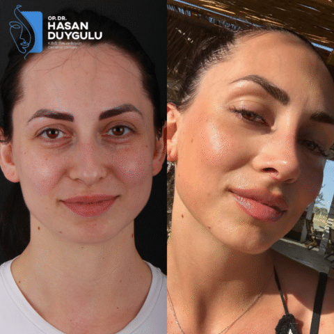 rinoplastika-operacija