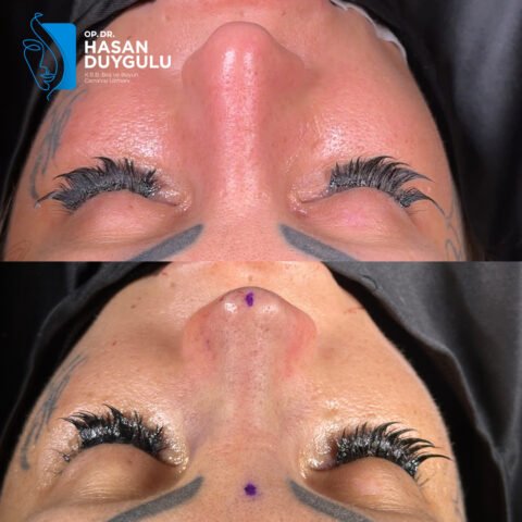 rinoplastika-operacija-nosa
