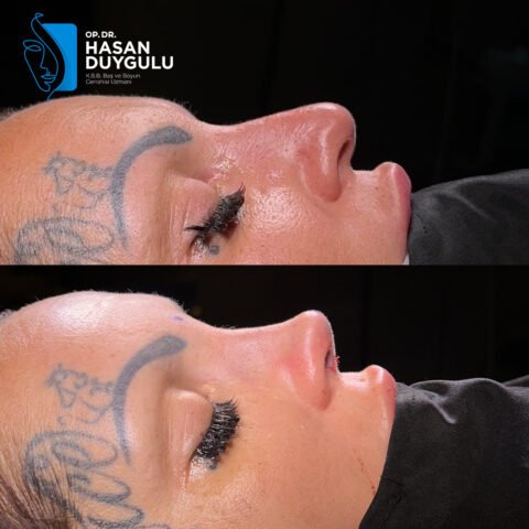 rinoplastika-posao-4