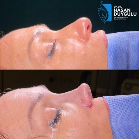 hirurg-rinoplastike-turska