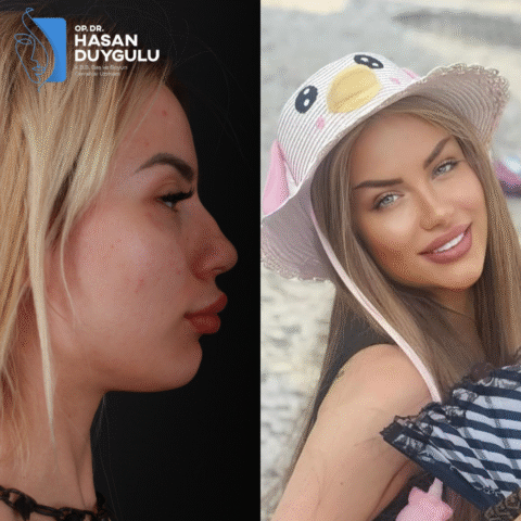 rinoplastika-operacija