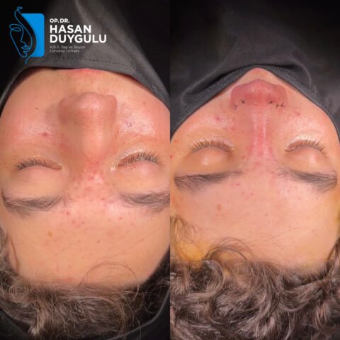 rinoplastika-operacija-u-turskoj