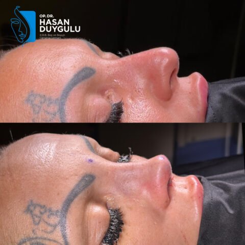 rinoplastika-posao-3